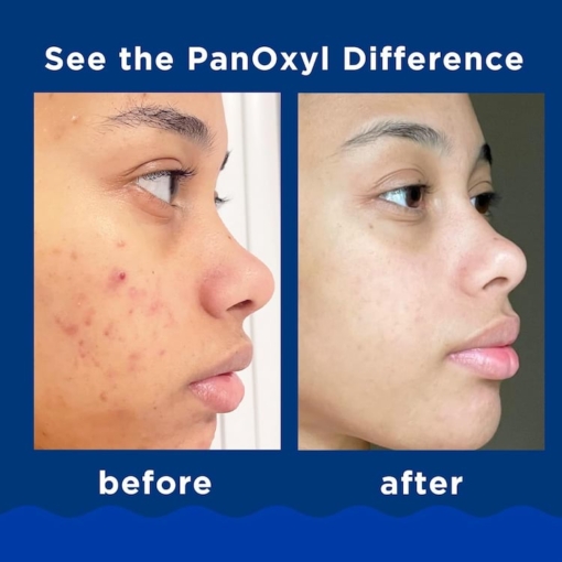 PanOxyl Acne Foaming Wash With 10% Benzoyl Peroxide Maximum Strength, 85 g